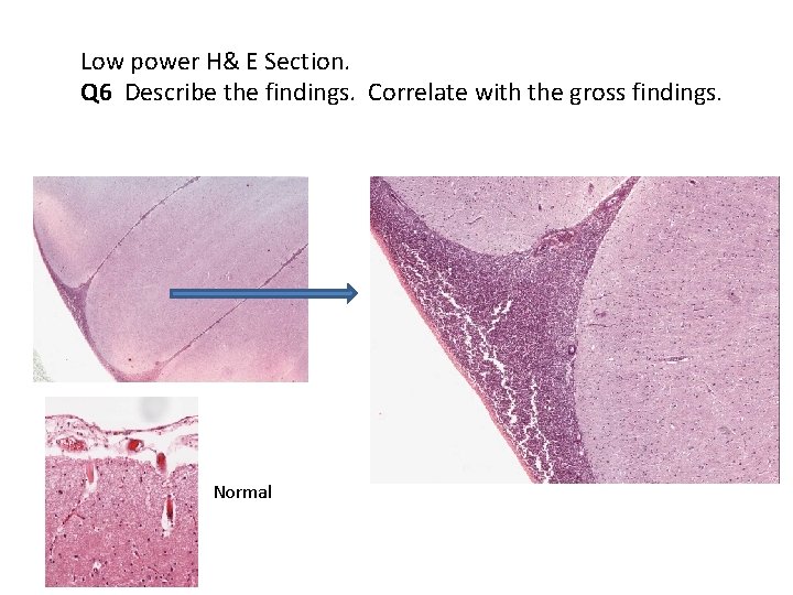 Low power H& E Section. Q 6 Describe the findings. Correlate with the gross