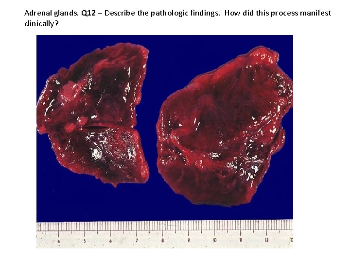 Adrenal glands. Q 12 – Describe the pathologic findings. ADRENALS clinically? How did this