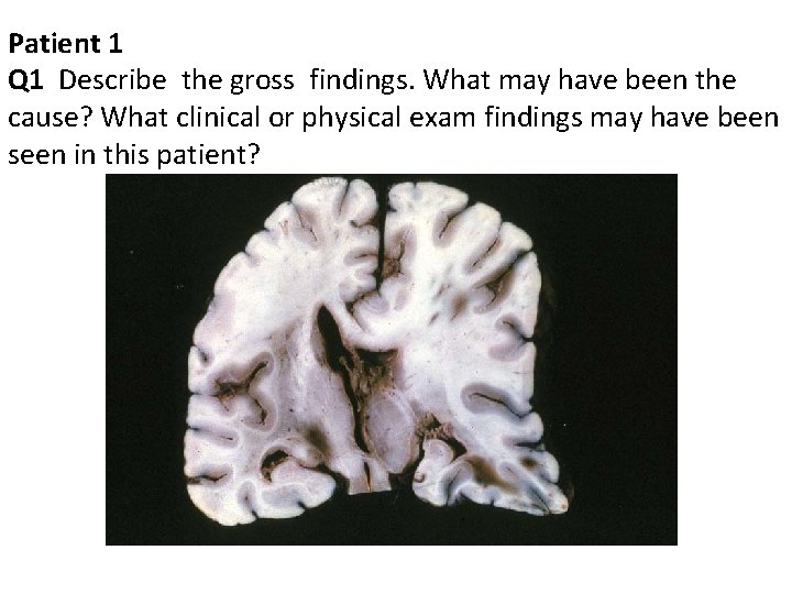 Patient 1 Q 1 Describe the gross findings. What may have been the cause?