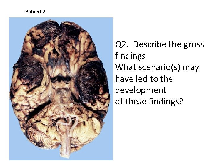Patient 2 Q 2. Describe the gross findings. What scenario(s) may have led to