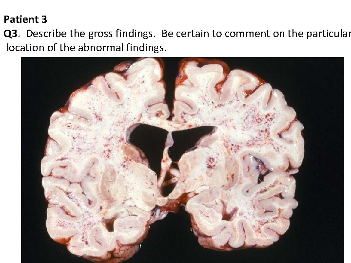 Patient 3 Q 3. Describe the gross findings. Be certain to comment on the