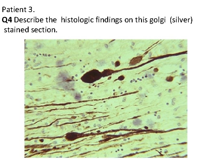 Patient 3. Q 4 Describe the histologic findings on this golgi (silver) stained section.