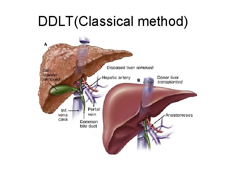 DDLT(Classical method) 