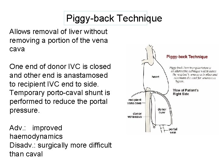 Piggy-back Technique Allows removal of liver without removing a portion of the vena cava.