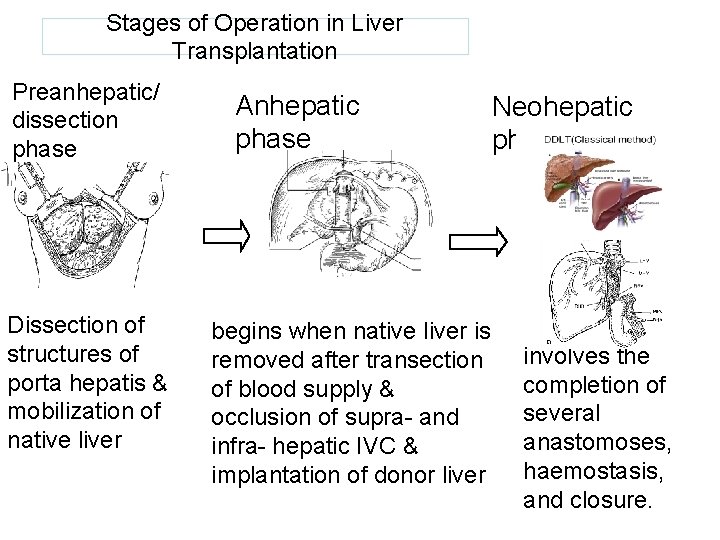 Stages of Operation in Liver Transplantation Preanhepatic/ dissection phase Dissection of structures of porta