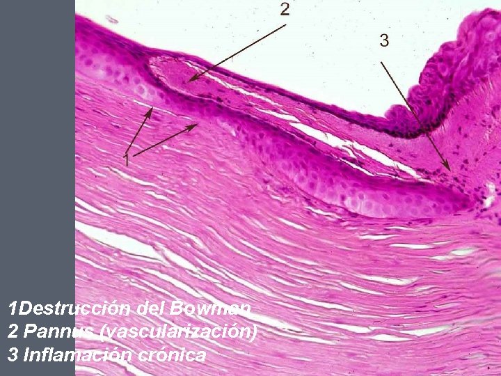 1 Destrucción del Bowman 2 Pannus (vascularización) 3 Inflamación crónica 