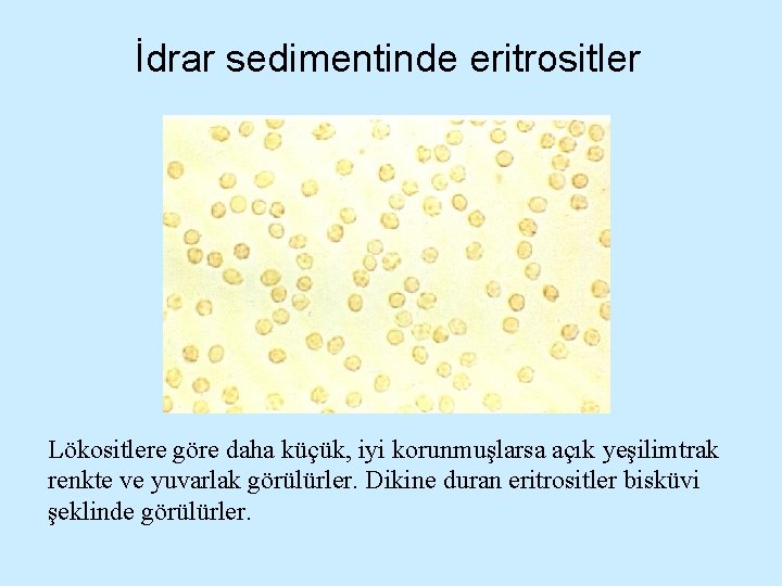 İdrar sedimentinde eritrositler Lökositlere göre daha küçük, iyi korunmuşlarsa açık yeşilimtrak renkte ve yuvarlak