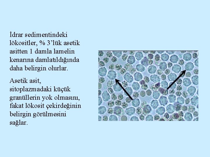 İdrar sedimentindeki lökositler, % 3’lük asetik asitten 1 damla lamelin kenarına damlatıldığında daha belirgin