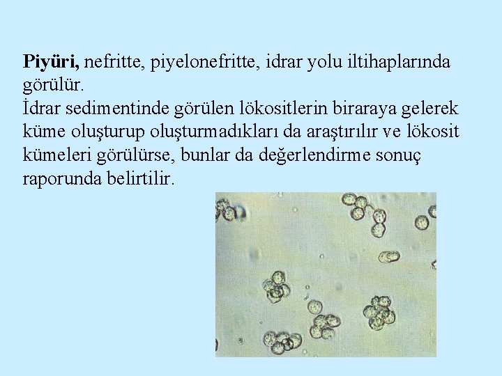 Piyüri, nefritte, piyelonefritte, idrar yolu iltihaplarında görülür. İdrar sedimentinde görülen lökositlerin biraraya gelerek küme
