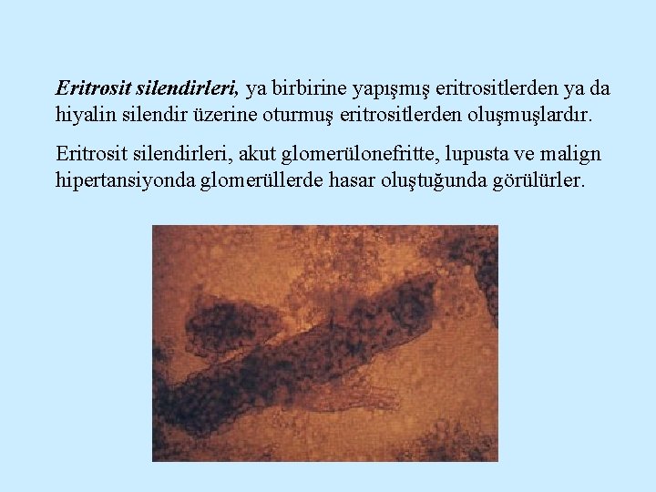 Eritrosit silendirleri, ya birbirine yapışmış eritrositlerden ya da hiyalin silendir üzerine oturmuş eritrositlerden oluşmuşlardır.
