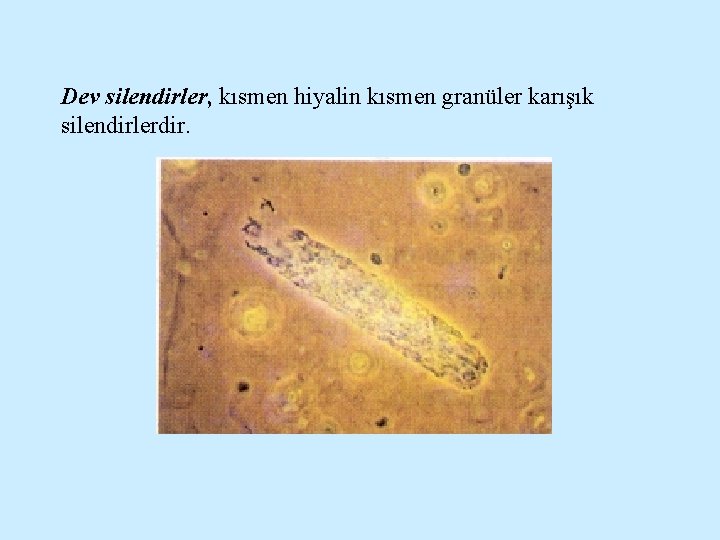 Dev silendirler, kısmen hiyalin kısmen granüler karışık silendirlerdir. 