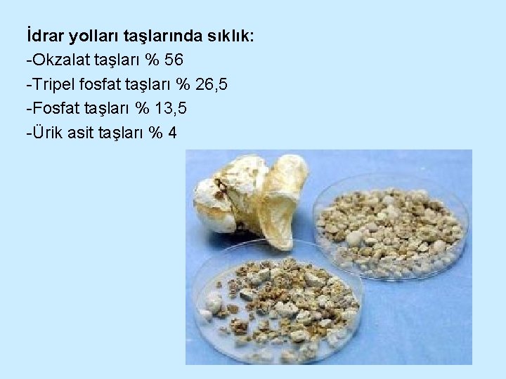 İdrar yolları taşlarında sıklık: -Okzalat taşları % 56 -Tripel fosfat taşları % 26, 5
