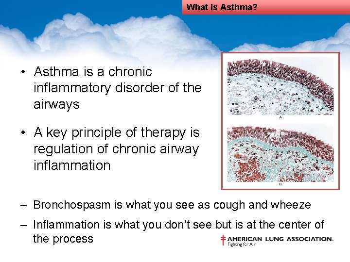 What is Asthma? • Asthma is a chronic inflammatory disorder of the airways •
