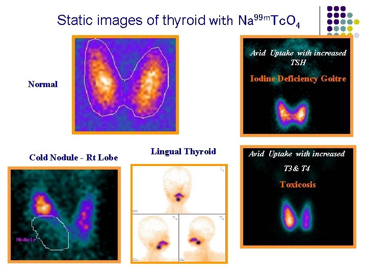 Static images of thyroid with Na 99 m. Tc. O 4 Avid Uptake with