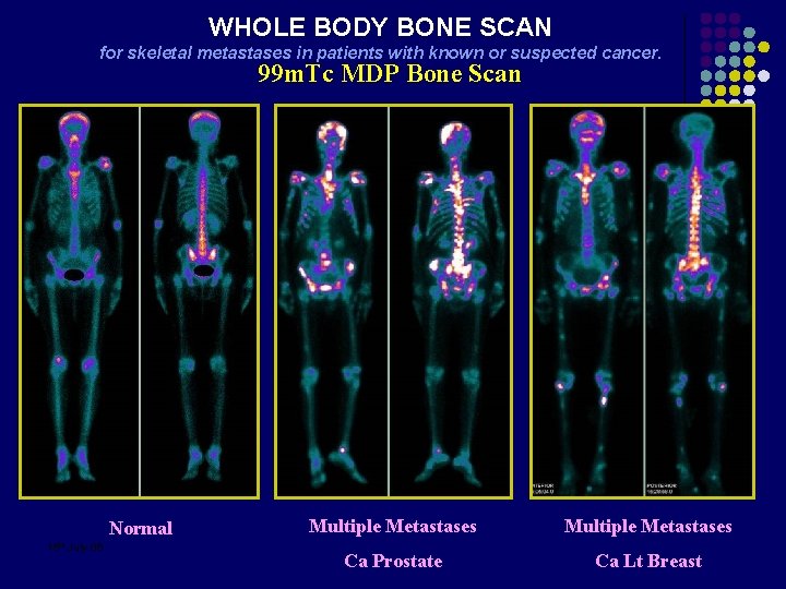 WHOLE BODY BONE SCAN for skeletal metastases in patients with known or suspected cancer.