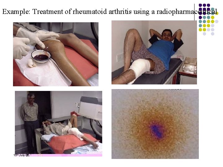 Example: Treatment of rheumatoid arthritis using a radiopharmaceutical 15 th July 06 