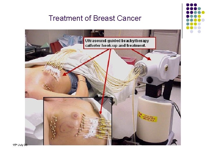 Treatment of Breast Cancer 15 th July 06 