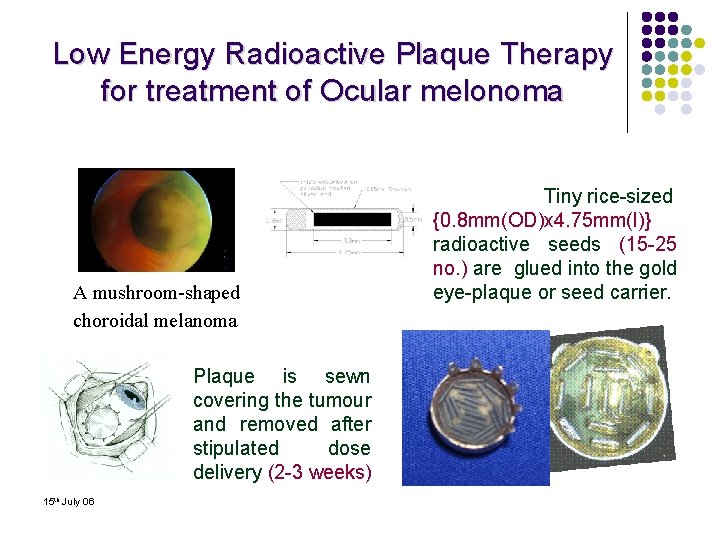 Low Energy Radioactive Plaque Therapy for treatment of Ocular melonoma A mushroom-shaped choroidal melanoma