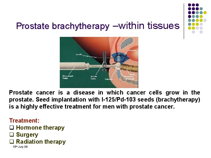 Prostate brachytherapy –within tissues . Prostate cancer is a disease in which cancer cells