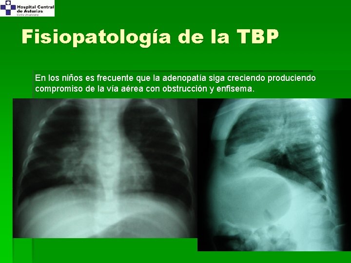 Fisiopatología de la TBP En los niños es frecuente que la adenopatía siga creciendo