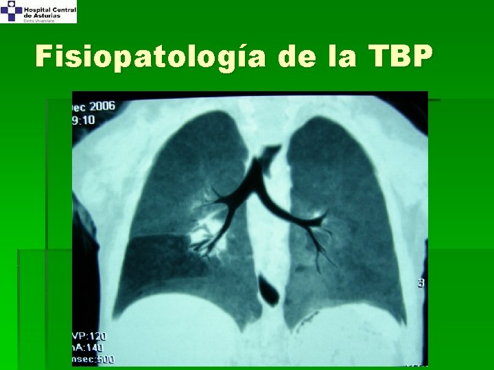 Fisiopatología de la TBP 