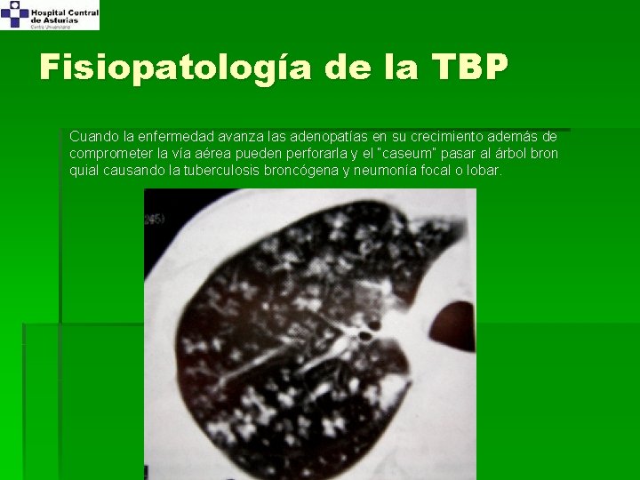 Fisiopatología de la TBP Cuando la enfermedad avanza las adenopatías en su crecimiento además
