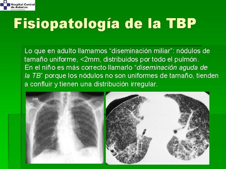 Fisiopatología de la TBP Lo que en adulto llamamos “diseminación miliar”: nódulos de tamaño