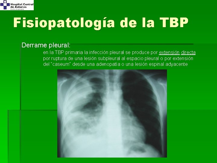 Fisiopatología de la TBP Derrame pleural: en la TBP primaria la infección pleural se