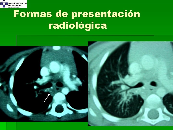 Formas de presentación radiológica 