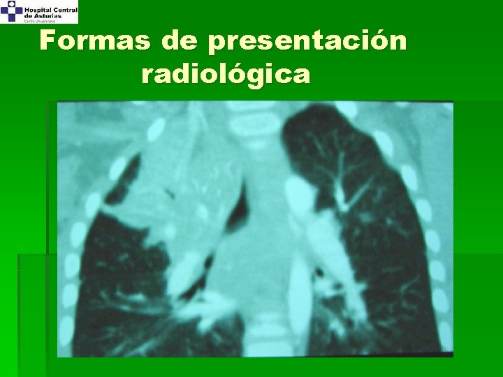 Formas de presentación radiológica 