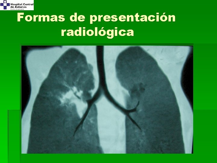 Formas de presentación radiológica 