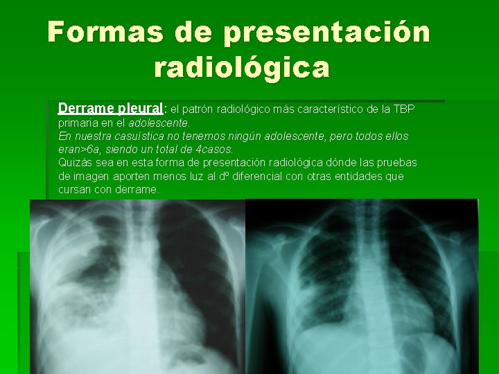 Formas de presentación radiológica Derrame pleural: el patrón radiológico más característico de la TBP