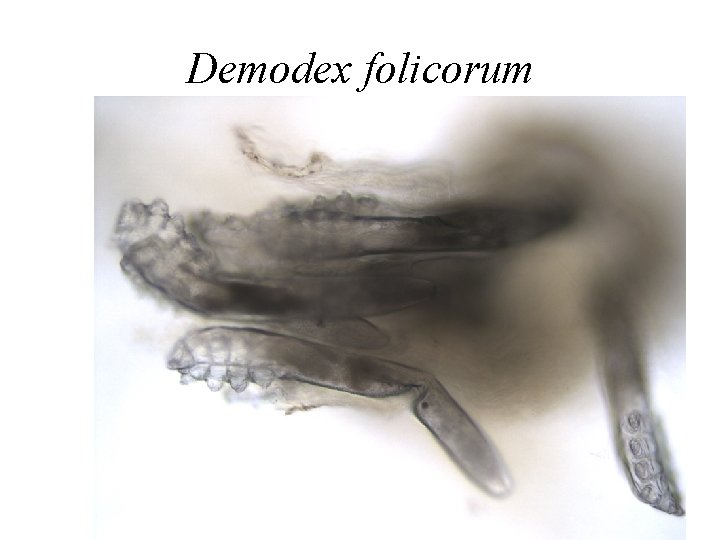 Demodex folicorum 