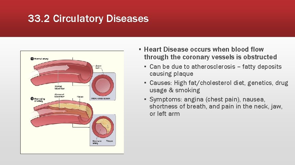 33. 2 Circulatory Diseases ▪ Heart Disease occurs when blood flow through the coronary