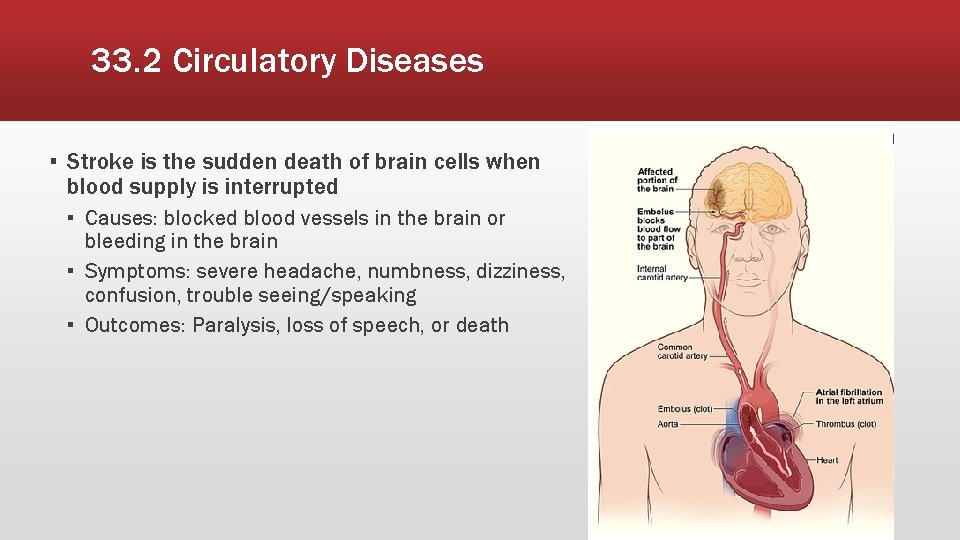 33. 2 Circulatory Diseases ▪ Stroke is the sudden death of brain cells when