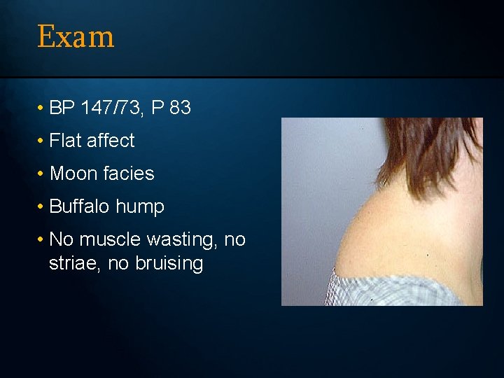 Exam • BP 147/73, P 83 • Flat affect • Moon facies • Buffalo