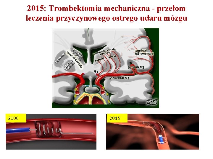 2015: Trombektomia mechaniczna - przełom leczenia przyczynowego ostrego udaru mózgu 2000 2015 