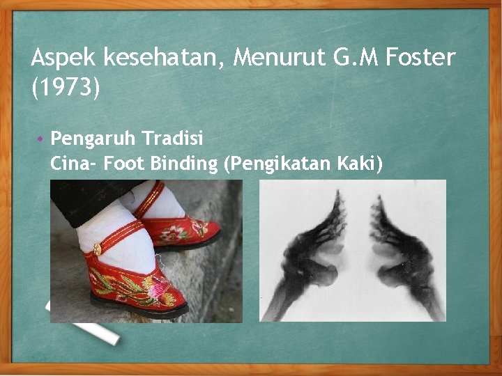 Aspek kesehatan, Menurut G. M Foster (1973) • Pengaruh Tradisi Cina- Foot Binding (Pengikatan