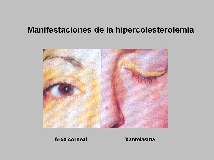 Manifestaciones de la hipercolesterolemia Arco corneal Xantelasma 