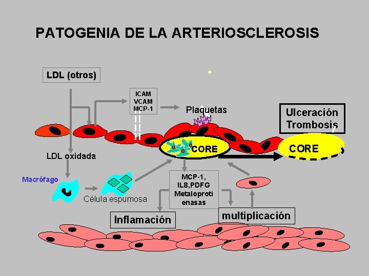 PATOGENIA DE LA ARTERIOSCLEROSIS LDL (otros) ICAM VCAM MCP-1 Plaquetas CORE LDL oxidada Macrófago