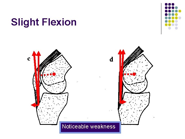 Slight Flexion Noticeable weakness 