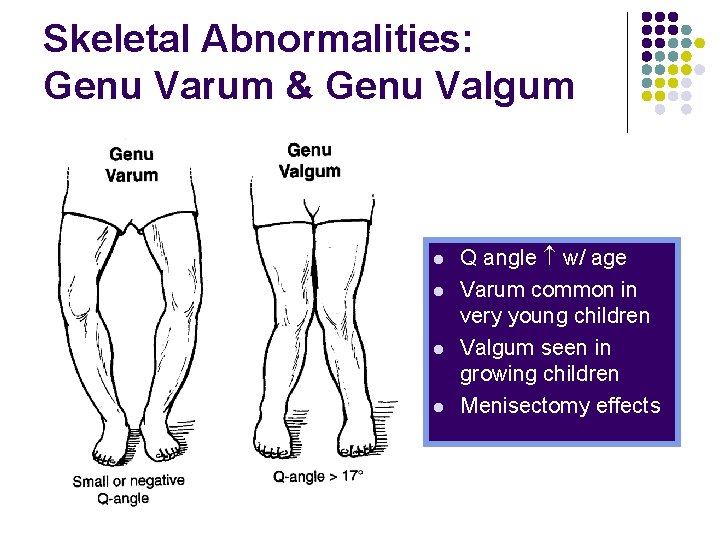 Skeletal Abnormalities: Genu Varum & Genu Valgum l l Q angle w/ age Varum