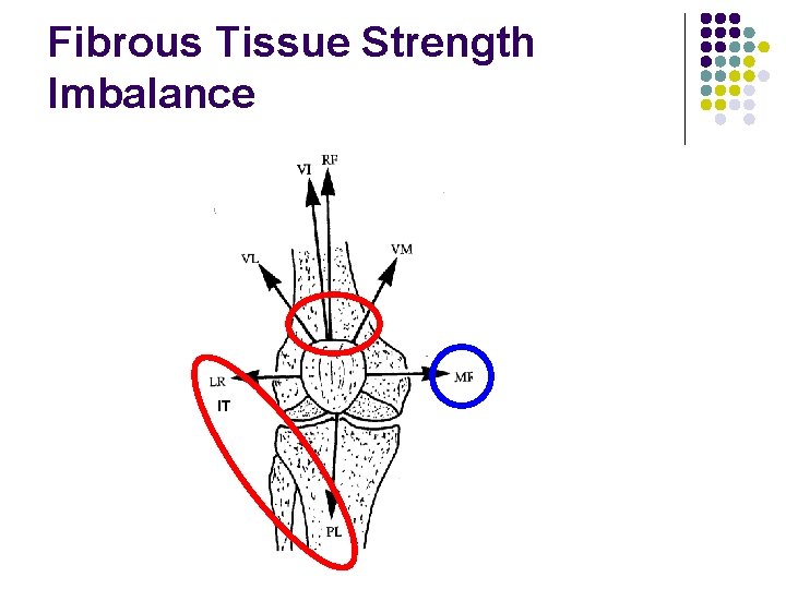 Fibrous Tissue Strength Imbalance IT 