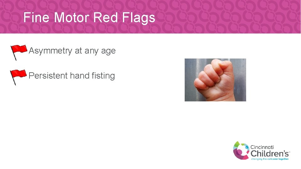 Fine Motor Red Flags • Asymmetry at any age • Persistent hand fisting 