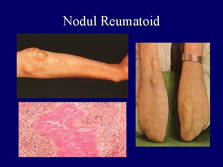 Nodul Reumatoid 