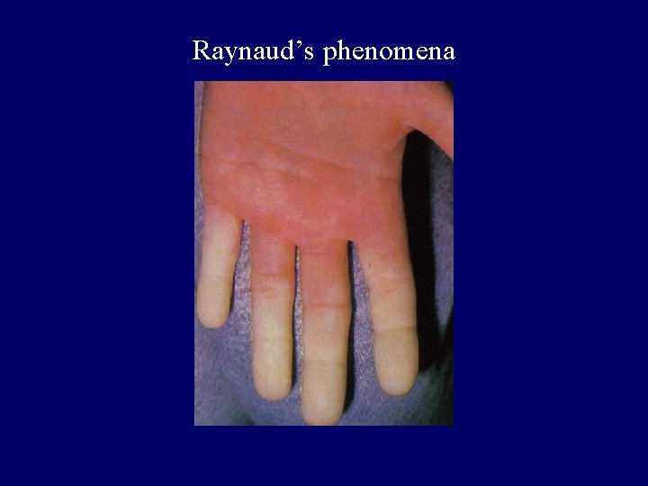 Raynaud’s phenomena 