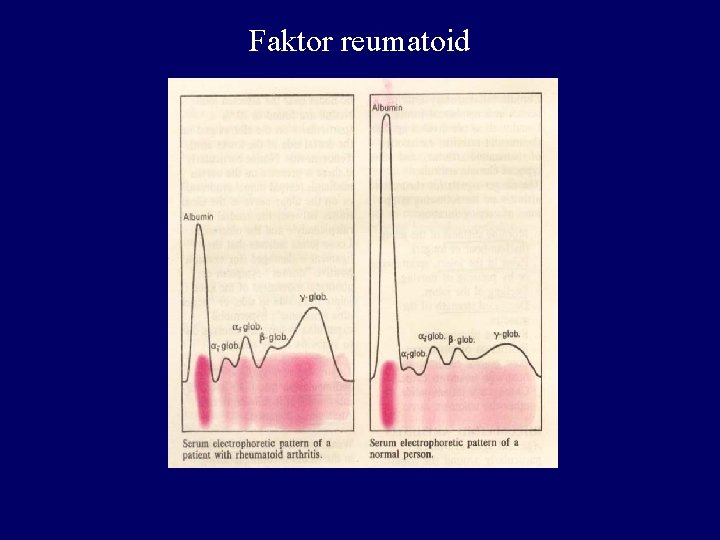 Faktor reumatoid 