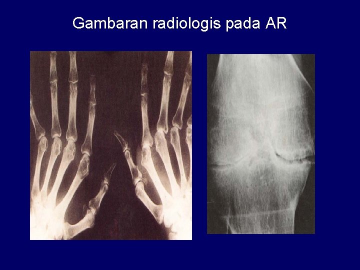 Gambaran radiologis pada AR 