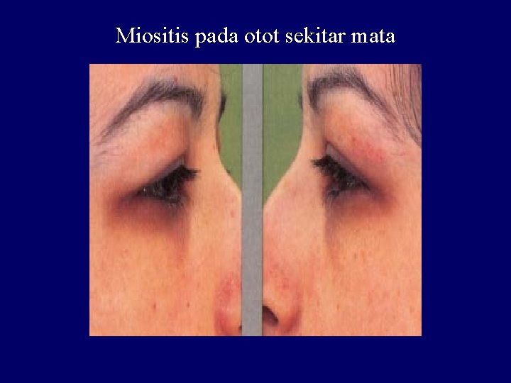 Miositis pada otot sekitar mata 