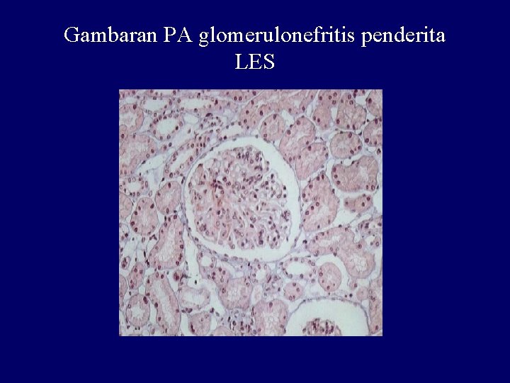 Gambaran PA glomerulonefritis penderita LES 